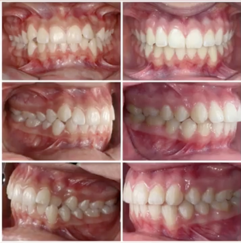 Comparación intraoral antes y después de un tratamiento de ortodoncia