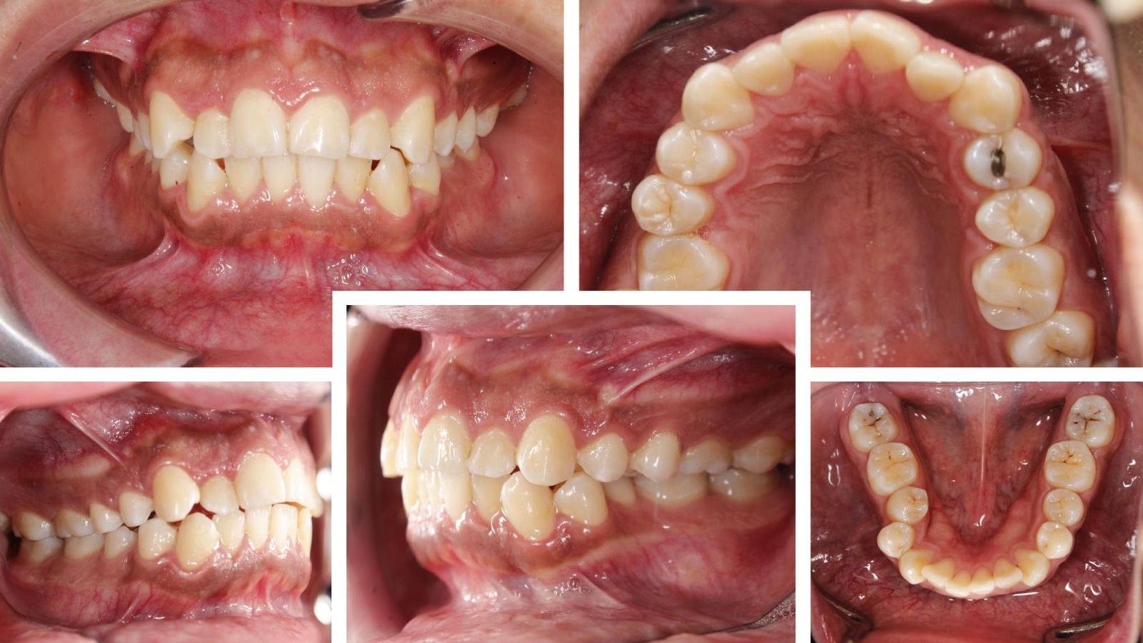Registros intraorales iniciales de un caso tratado con brackets de autoligado