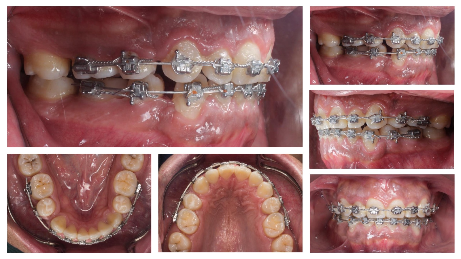 Registros intraorales durante un tratamiento con brackets de autoligado